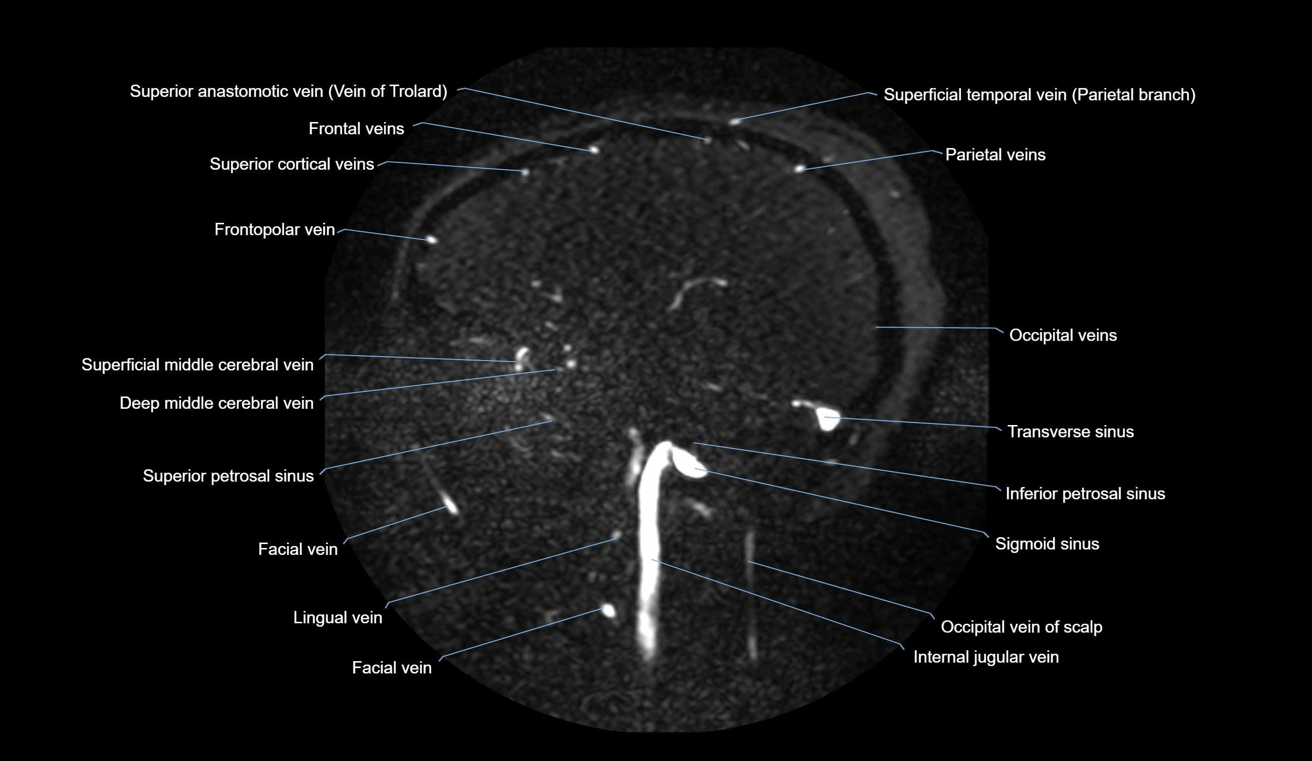 MRV brain sagittal anatomy 3T MRI labelledimages -00027.webp